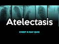 Atelectasis: Chest X-ray Quiz