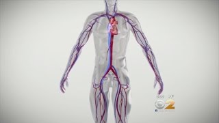 Dr. Max Gomez: Heart Failure Device