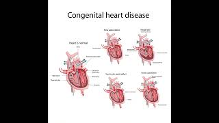 Congestive Heart Failure