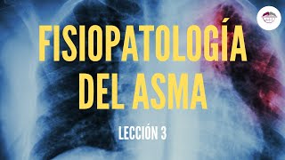 3. FISIOPATOLOGÍA DEL ASMA (FISIOPATOLOGÍA RESPIRATORIA)