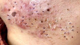 relax,Satisfying,nose blackheads,tweezers,acne treatment,鼻角栓,ピンセット,피지제거_ 角栓　除去  #090