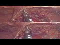 3d thymectomy vats video assisted thoracoscopic surgery