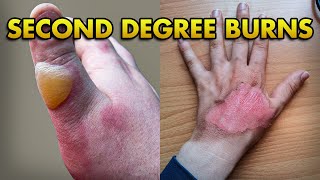 2nd Degree Burn: Superficial and Deep Partial Thickness Burns Explained