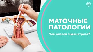 Маточные патологии. Миома, эндометриоз, удаление матки. Скажите, доктор!