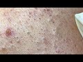 The best acne squeezing collection form Linh Mun Spa part 13