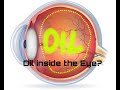 13: How long can you leave Silicone Oil inside the eye/ RETINAL DETACHMENT/ #retinaldetachment