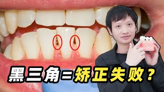 牙齿矫正期间出现黑三角就等于矫正失败！？真的完全不可逆了吗？