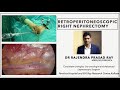 Retroperitoneoscopic Right Simple Nephrectomy I Advanced Laparoscopic Surgery I MIS I Urology