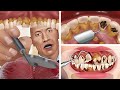 The Rock helps remove tartar and treat tooth decay | ASMR