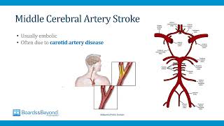 Neurology Step 2-3 — Stroke II — Boards and Beyond