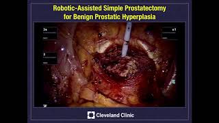 Robot-Assisted Simple Prostatectomy for Benign Prostatic Hyperplasia