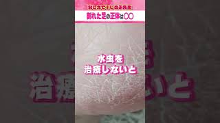 【注意】ガサガサで割れた足の正体 #shorts #皮膚科 #しのぶ先生