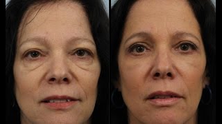 Selfie Generation Undergoes Blepharoplasty for Tired Eyes