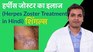 हर्पीस जोस्टर (herpes zoster) या  shingles क्या है? इसके कारण, लक्षण और इलाज | Herpes Zoster ka Ilaj