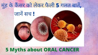 मुंह के कैंसर को लेकर फैली 5 गलत बातें,  जानें सच ! 5 Myths about ORAL CANCER