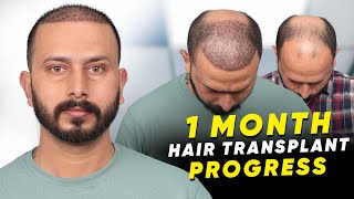 Hair Transplant in Kota | Best Results \u0026 Cost of Hair Transplant in Kota