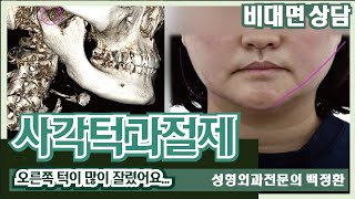 (SUB) 사각턱수술 후 개턱 됐어요.. 재건해야 할까요?  [비대면상담 #106] / After square jaw surgery, my jaw became round...