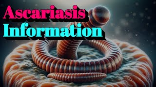 Ascariasis Information (🔬Tier.4 Infectious Disease)