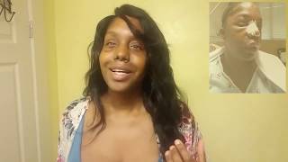 FFS post op update - Ms Elle Presents