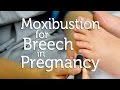 Moxibustion for Breech in Pregnancy