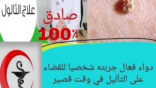 اقوى وافضل دواء للقضاء على الثآليل في جسمك ..جربته شخصيا ✔✔✔