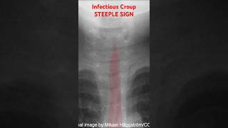 Infectious Croup X-ray: Steeple Sign