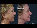 co2 fractional laser resurfacing before and after video dr. david stoker