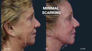 CO2 Fractional Laser Resurfacing | Before and After Video | Dr. David Stoker