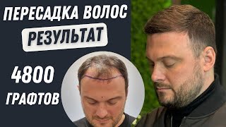 Пересадка Волос До и После 5000 графтов | Пересадка волос в Турции #пересадкаволос