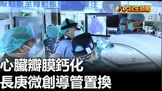 心臟瓣膜鈣化 長庚微創導管置換 |【民生八方事】| 2023081509 @gtvnews27