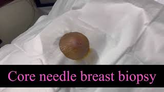 Core needle breast biopsy