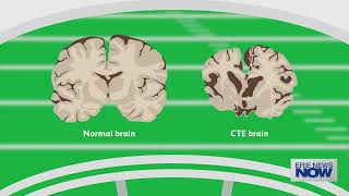 Steve Santagati Opens Up About Life After Traumatic Brain Injury