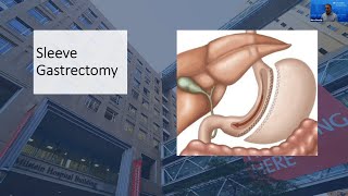 Weight Loss Surgery Q&A: Sleeve Gastrectomy