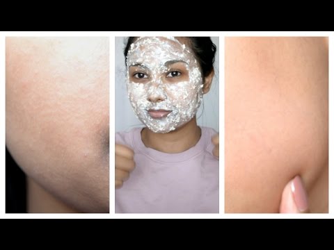 How To Get Rid of Heat Rash / Prickly Heat Naturally DIY How To Get Rid of Heat Rash / Prickly Heat Naturally DIY