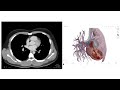 46の①【栄養士が知りたい画像 初級編 _胸部ct】how to read chest ct scan for dietitian