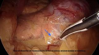 Laparoscopic Distal pancreatectomy (Standard) (Non - RAMPS)