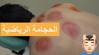 ايش فائدة الحجامة للرياضي ؟