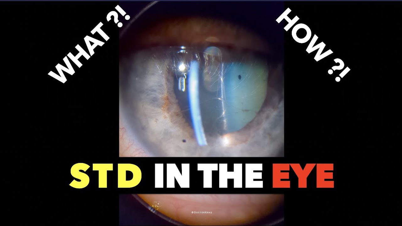 STD In The Eye | Syphilis | Uveitis - YouTube