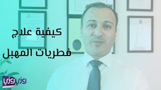 كيفية علاج فطريات المهبل