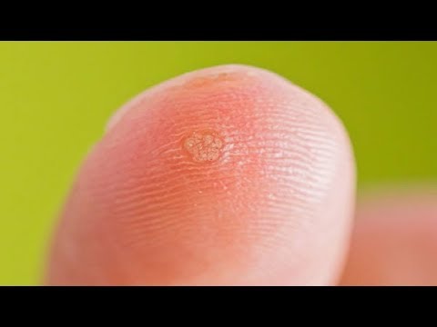 5 Effective Ways to Get Rid of Warts Naturally 5 Effective Ways to Get Rid of Warts Naturally