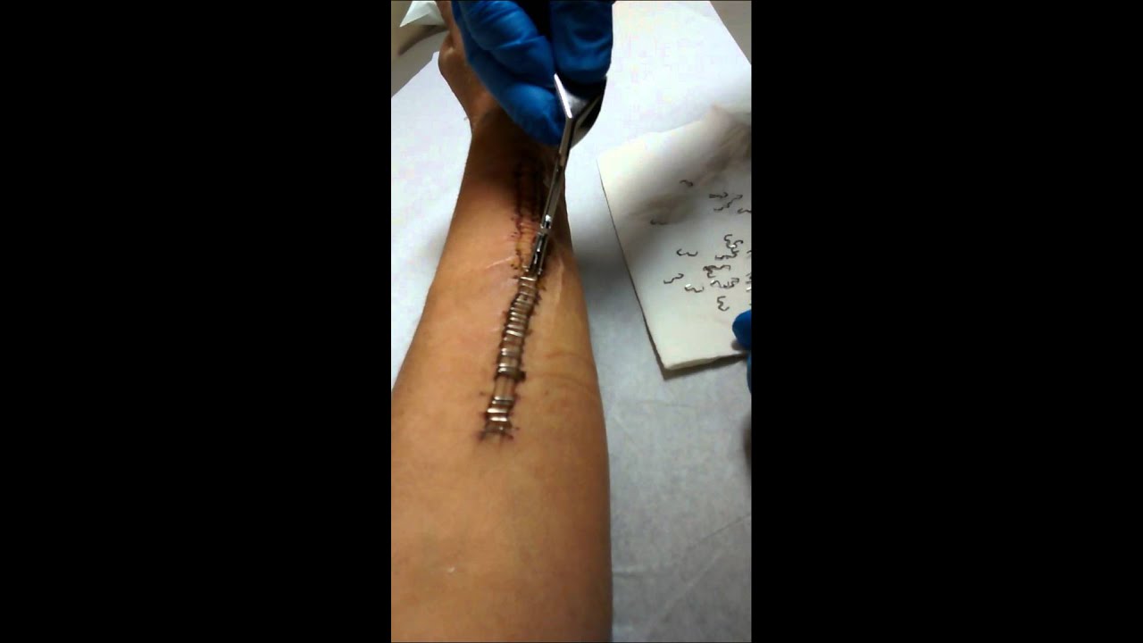 Removing Surgical Staples - YouTube