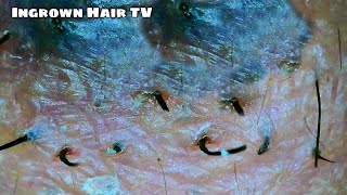 Ingrown Hair Removal Satisfying 2022 Mole Skin