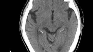 CNS C6 Hemorrhagic metastases (B)