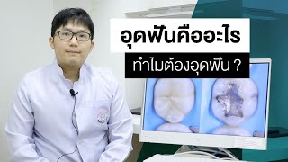 อุดฟันคืออะไร ทำไมต้องอุดฟัน? : ทันตกรรมสีวลีมีคำตอบ