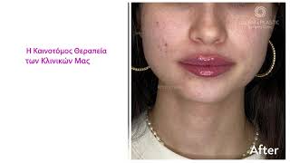 Υαλουρονικό στα Χείλη Πριν και Μετά - Superstar Lips #lipfiller #lipaugmentation #υαλουρονικό