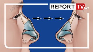 Ja kur është mosha ideale për të korrigjuar hundën