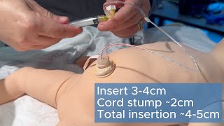 How to Place an Umbilical Venous Catheter - UVC