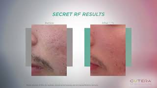 RF Microneedling \u0026 Technology at Kingsway Dermatology \u0026 Cosmetic Centre | Toronto, ON