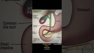 Cholecystitis - inflammation of the gallbladder #fypシ #foryou #fyp #educational  #cholecystitis #4u