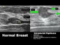 breast ultrasound normal vs abnormal image appearances comparison bi rads classification usg